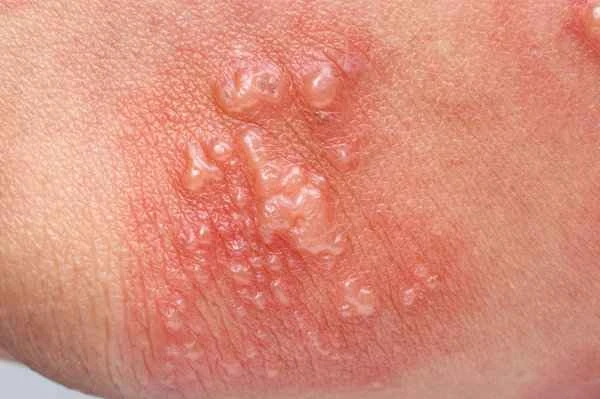 Does genital shingles cause itching?