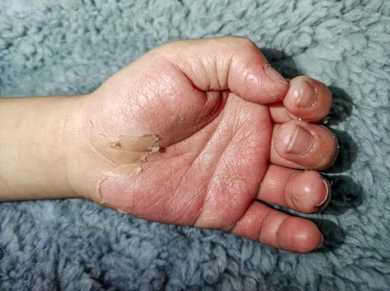 What medicine is the fastest and most effective for treating infantile eczema? A bath is also beneficial.