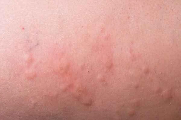 Can people with chronic urticaria eat pork liver?