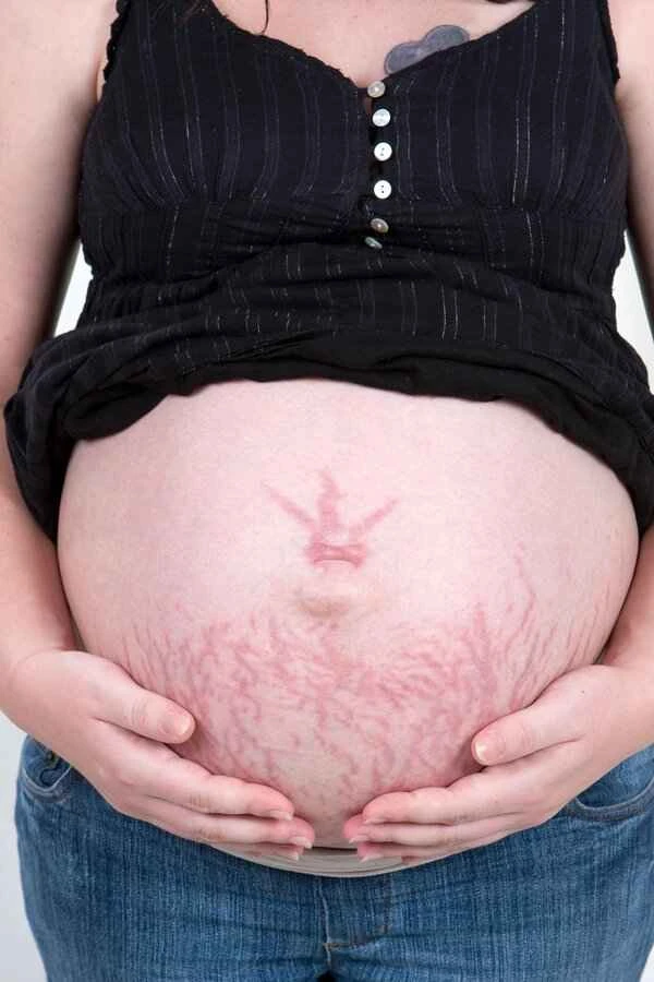 Will stretch marks disappear after childbirth due to abdominal fat accumulation?