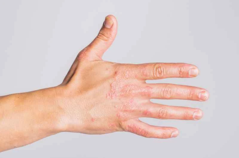 What foods are effective for treating urticaria?