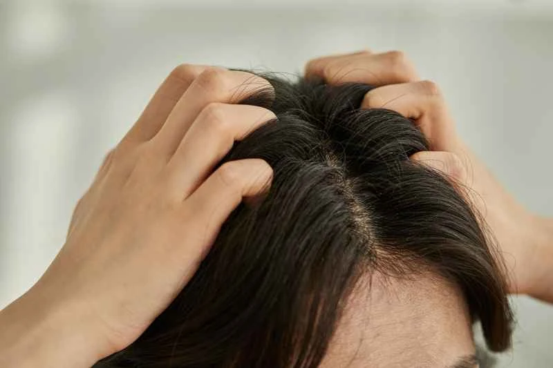 How to treat dandruff caused by psoriasis?