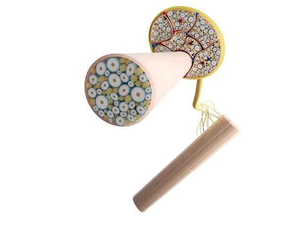 What can be done about a scar compressing a nerve root?