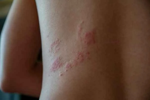 What to eat for chronic allergic urticaria