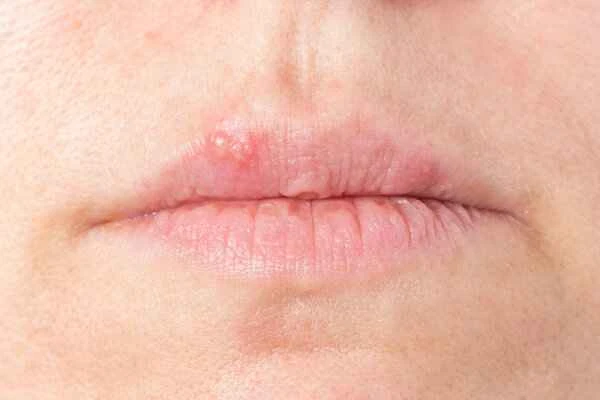 How to treat cold sores quickly?