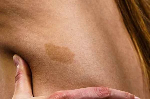 How long does it take for a scar to turn white?