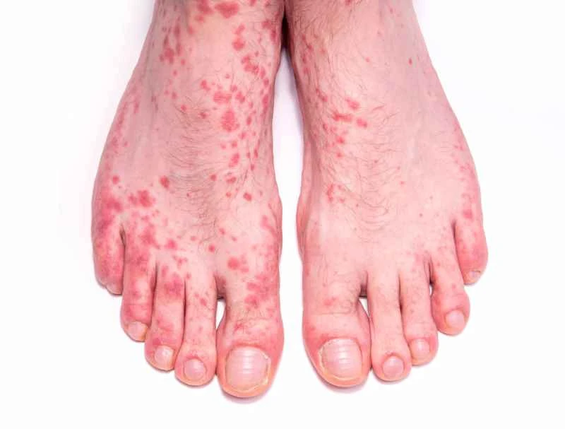 How long does it take to cure urticaria with medication?