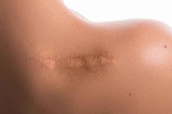 What is the best treatment for keloid scarring?