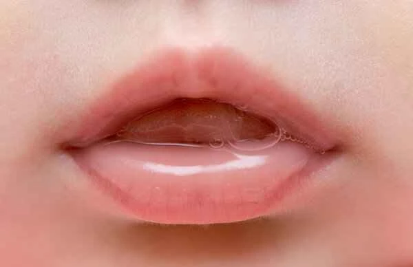 Will the dead skin on my lips peel off if I have cheilitis?