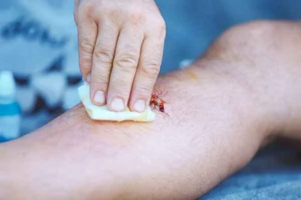 How to bathe with keloid scars