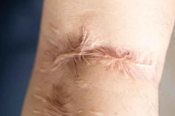 What to do about enlarged scars?