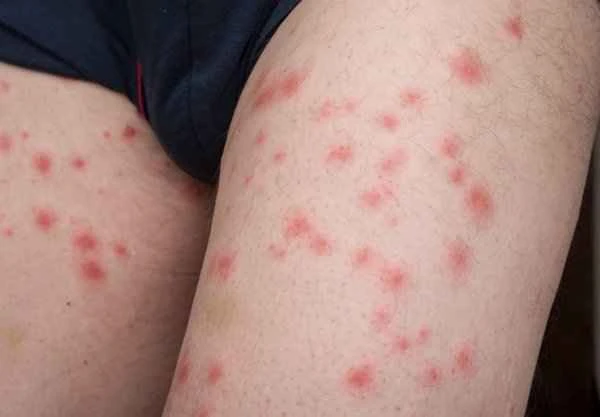 How to treat the rash that appears after the fever subsides?