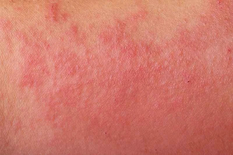 Can dermatitis eczema be cured completely?
