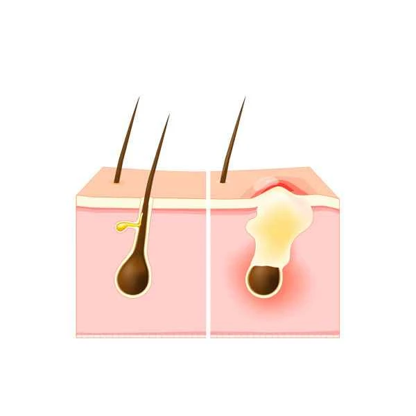 How to distinguish between acne and scar tissue