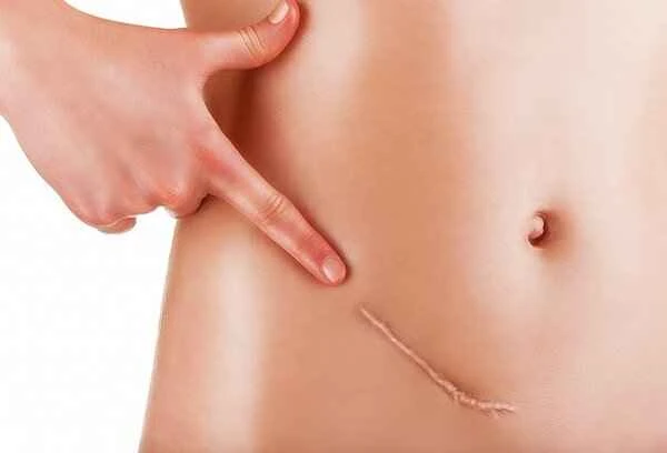 The white scars from the pterygium will disappear.