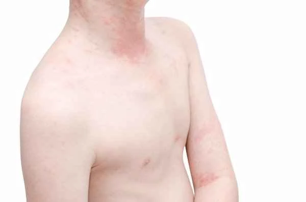 How to distinguish between urticaria and prickly heat