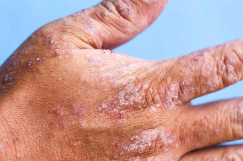 Will dry eczema spread?
