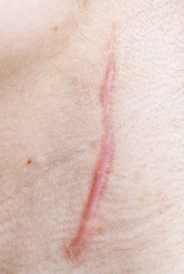 How to remove scars after injections