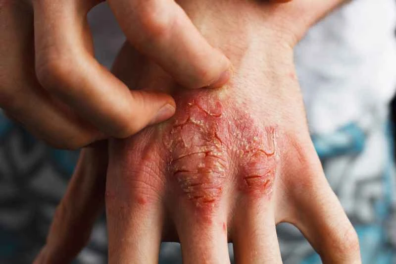 What diseases can dry eczema cause?