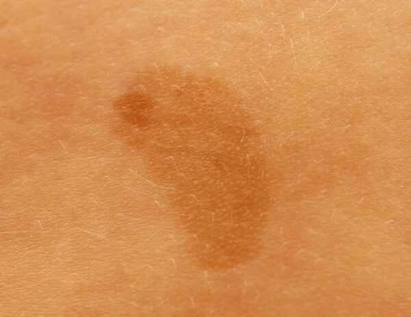 vulvar seborrheic keratosis