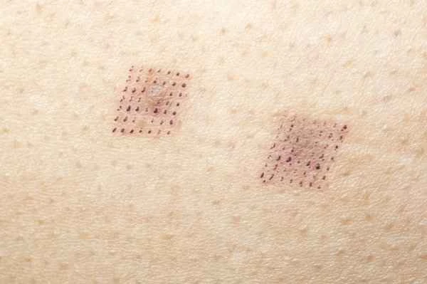 How to soften subcutaneous scar scabs