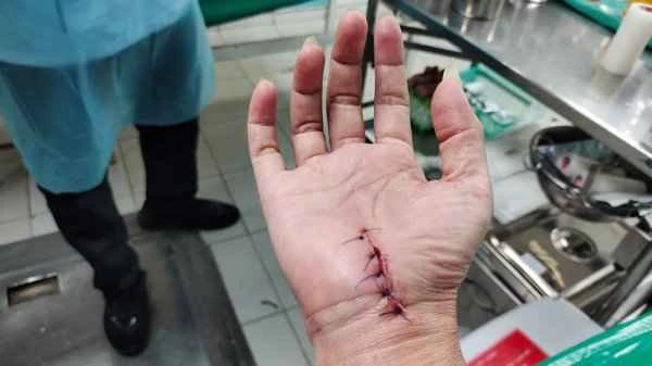 What to do about numbness in the arm after suture scarring?