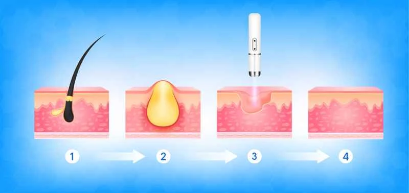 What medications can help adult urticaria subside quickly?