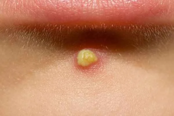 How to remove acne scars on the jawline