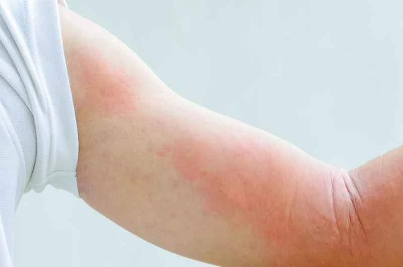 What foods are suitable for people with urticaria?