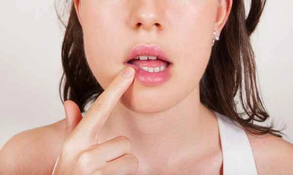 Is herpes cheilitis contagious in children?