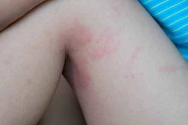 How to make hives disappear quickly