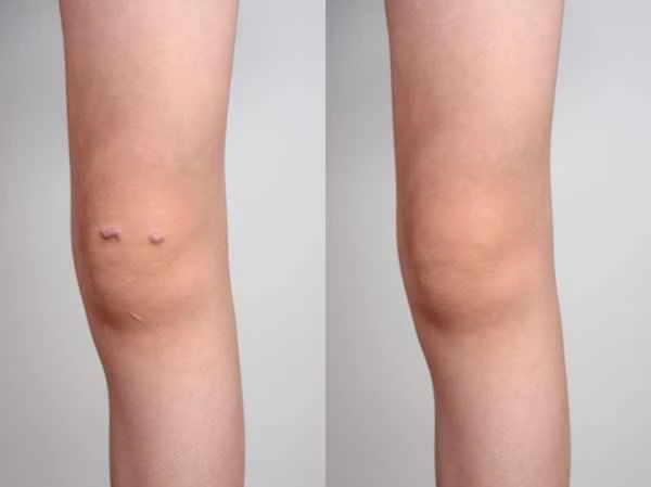 How to remove scars after ACL surgery