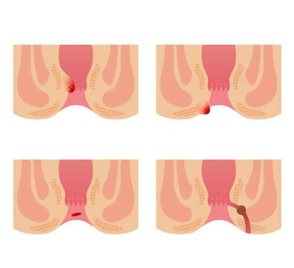 There's a hard, painful lump below my anus.