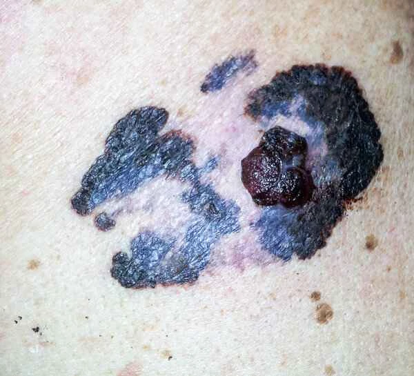 The chances of a black mole on the sole of the foot becoming malignant.