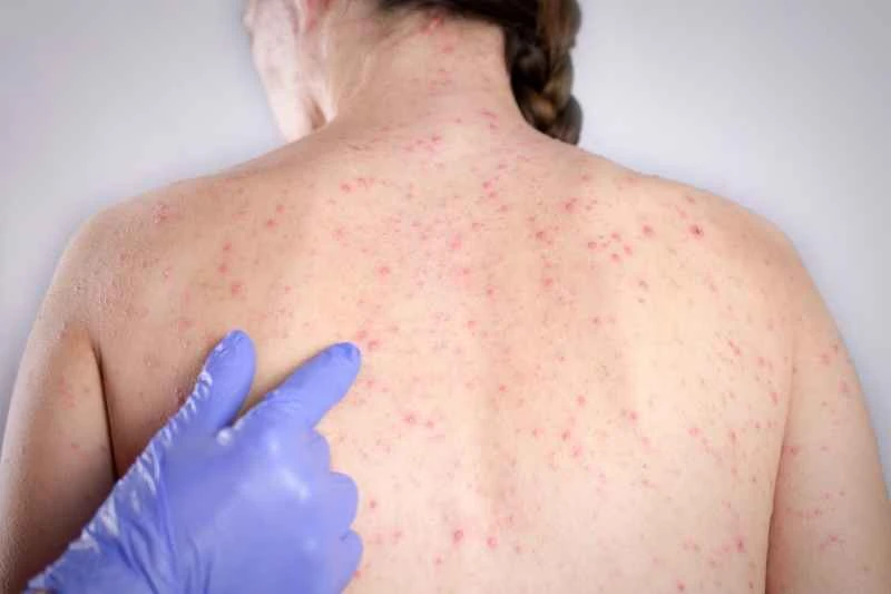 Is urticaria an infectious disease? (Medical Encyclopedia)