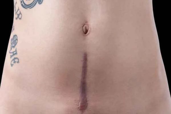 How to describe an abdominal scar examination?