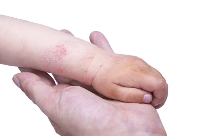 What does eczema look like in children?
