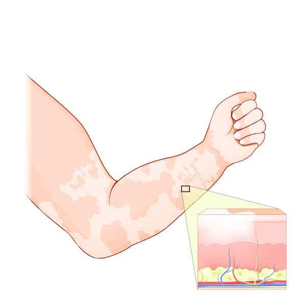 Can vitiligo patients undergo skin grafting?