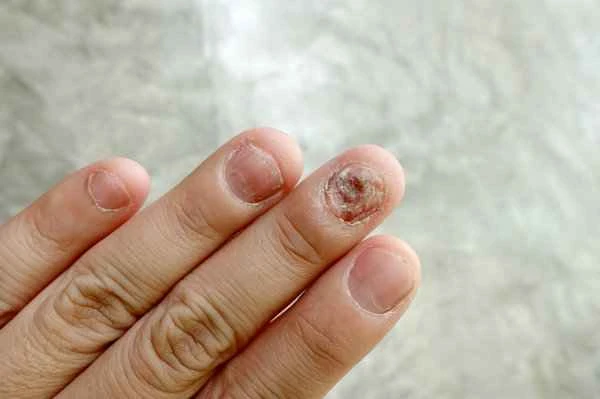 How long does it take to repair scars on fingers?