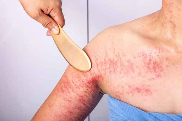 How long does it take to treat acute urticaria?