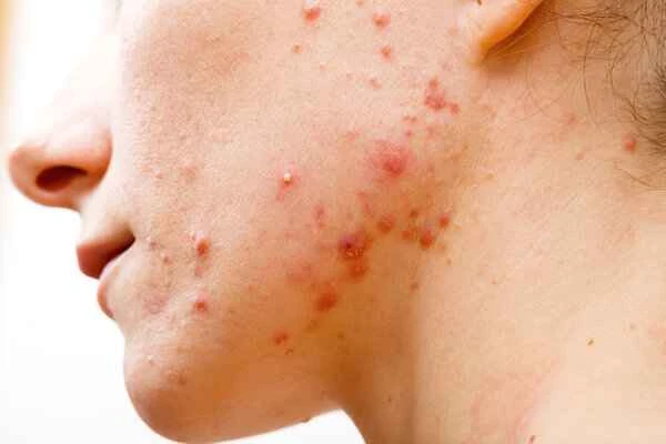 How to care for acne scars