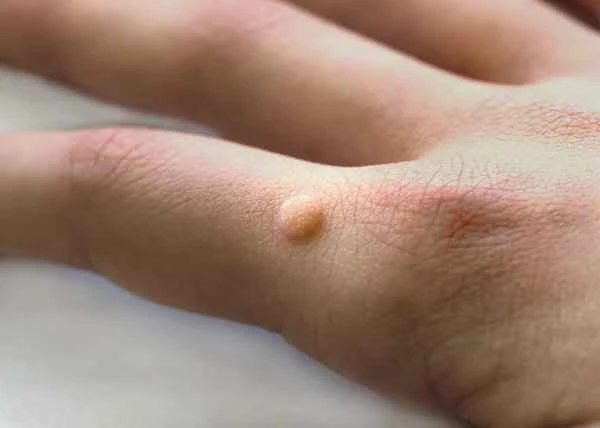 How to remove keloid scars on hands