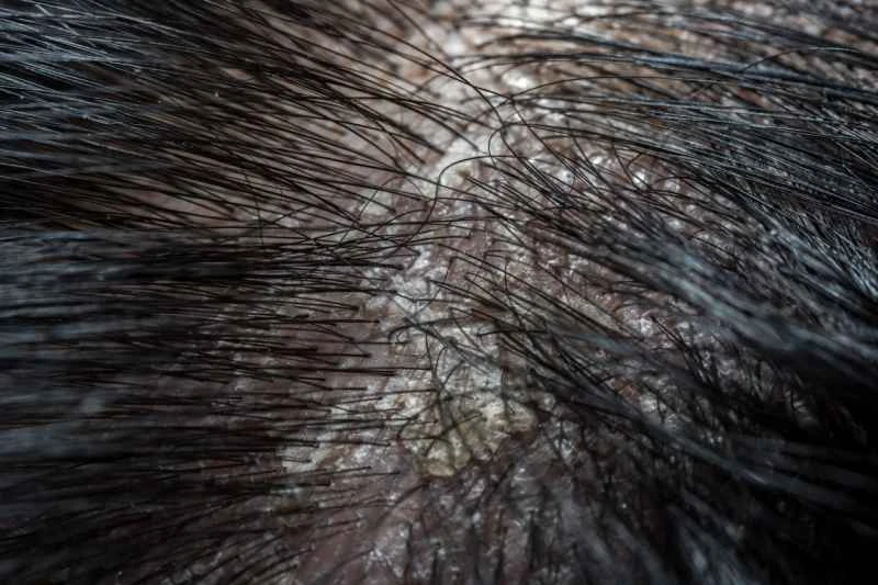 How can scalp psoriasis be cured completely?