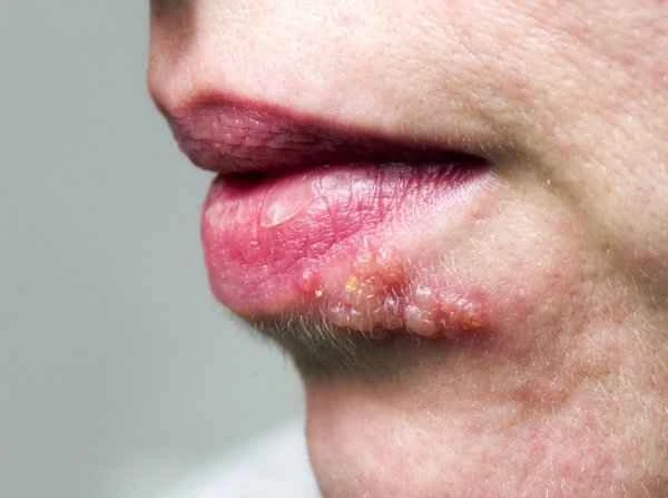 Is peeling skin in the middle of the upper lip a sign of cheilitis?