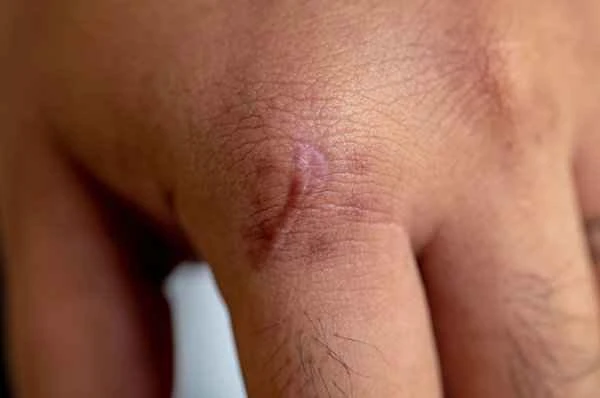 How to treat superficial keloids