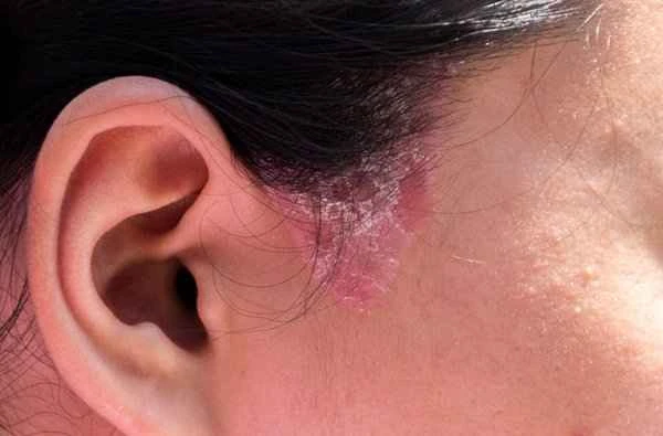 What causes keloid scars from ear piercings?