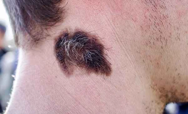 How to prevent hair growth on scars?
