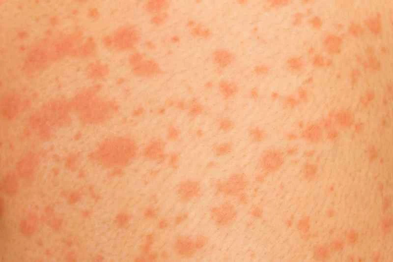 What should patients with urticaria eat?