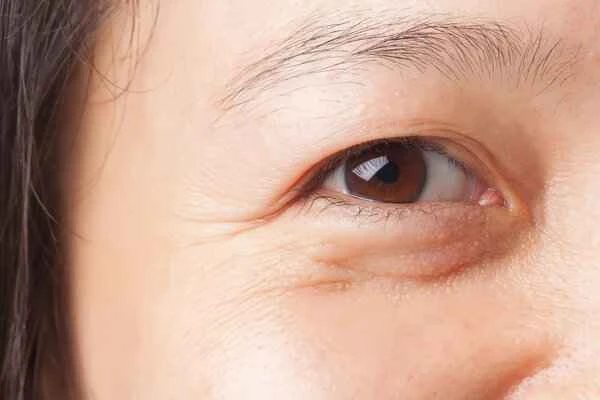 How long is the scar hyperplasia period after eyelid surgery?