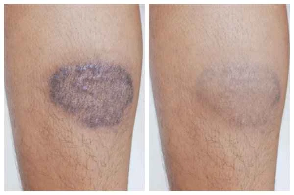 How to describe pressure ulcer scars?